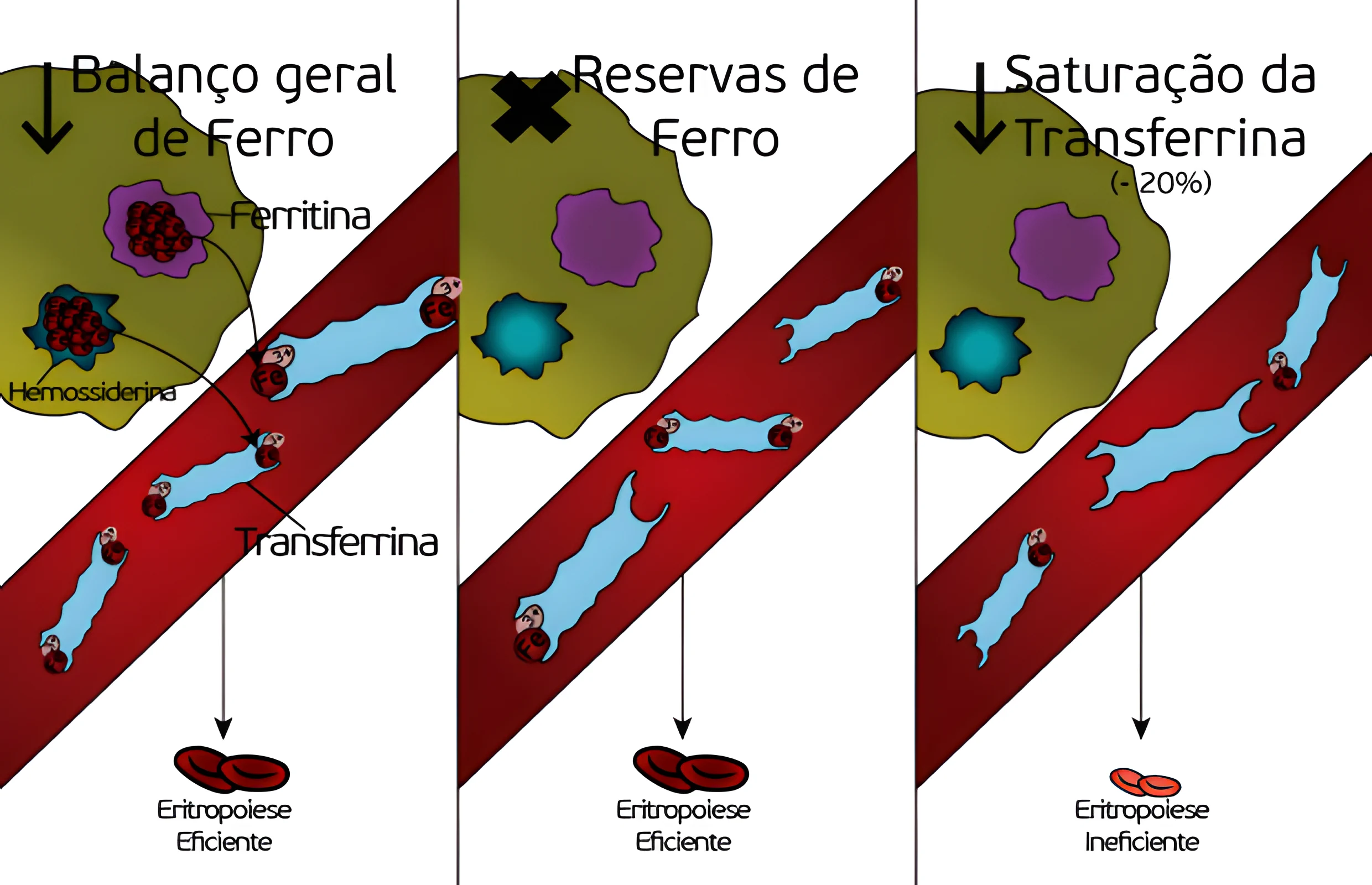 Anemia Ferropriva