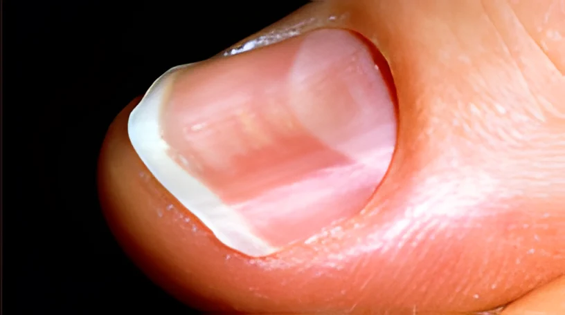 Anemia Ferropriva
