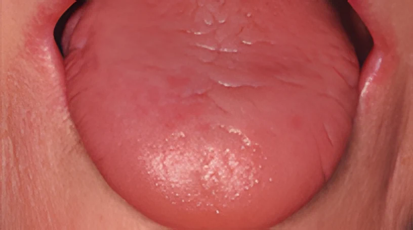 Anemia Ferropriva